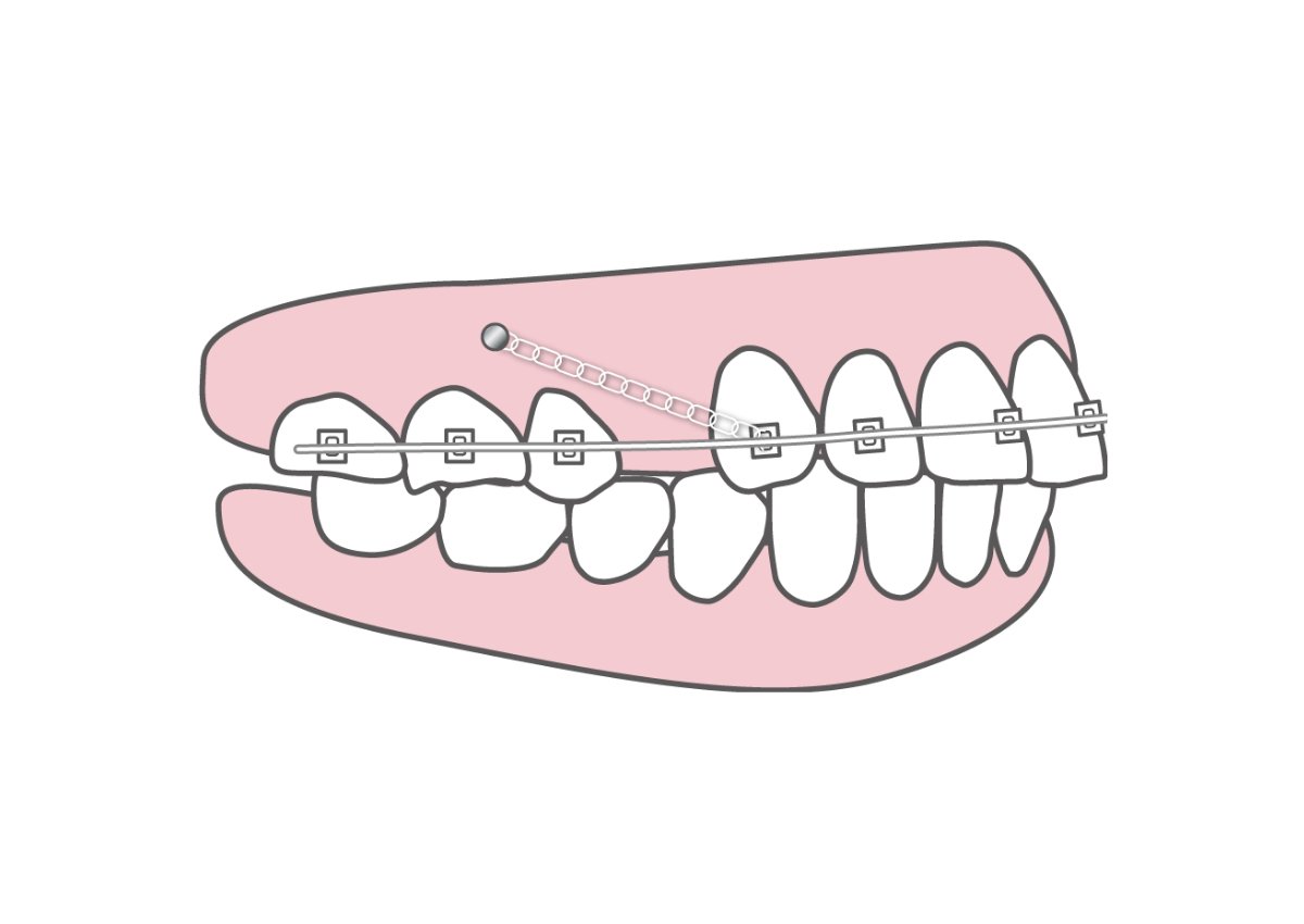 歯科矯正用アンカースクリューとは