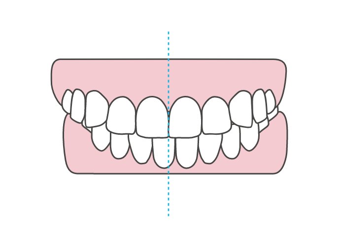 歯の中心がズレている・左右差（偏位）