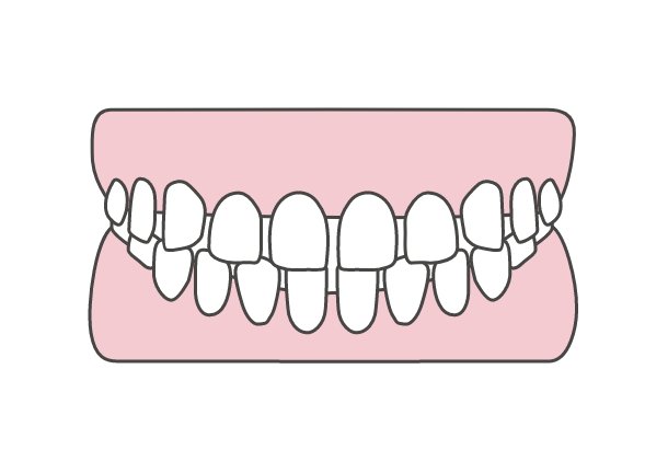 前歯の隙間（すきっ歯）