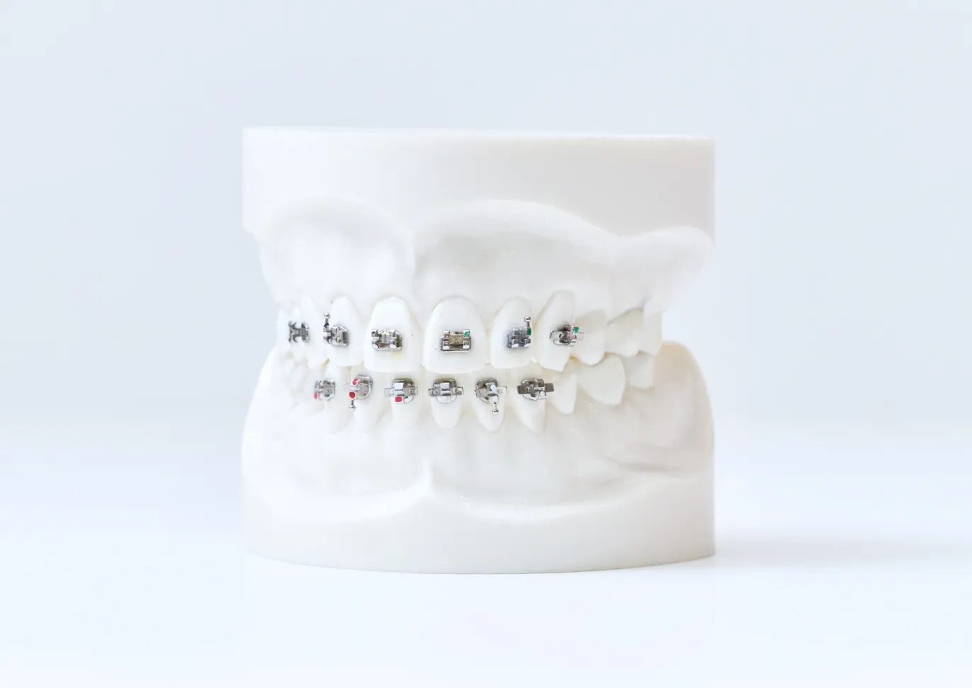 部分的な矯正｜守山 栗東 野洲 湖南 甲賀 まおか矯正歯科