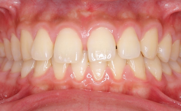すきっ歯の治療例