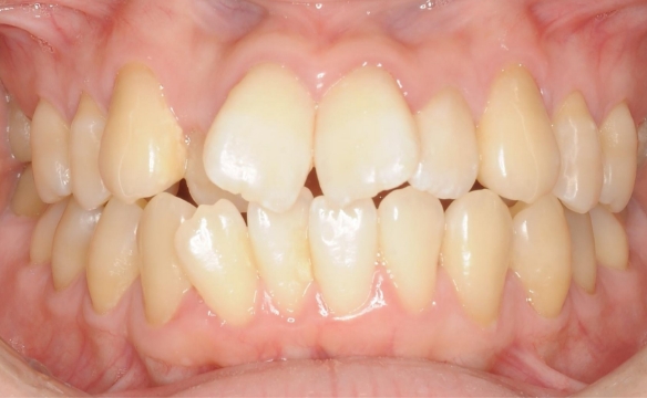 クロスバイトを伴う叢生（ガタガタの歯並び）の治療例
