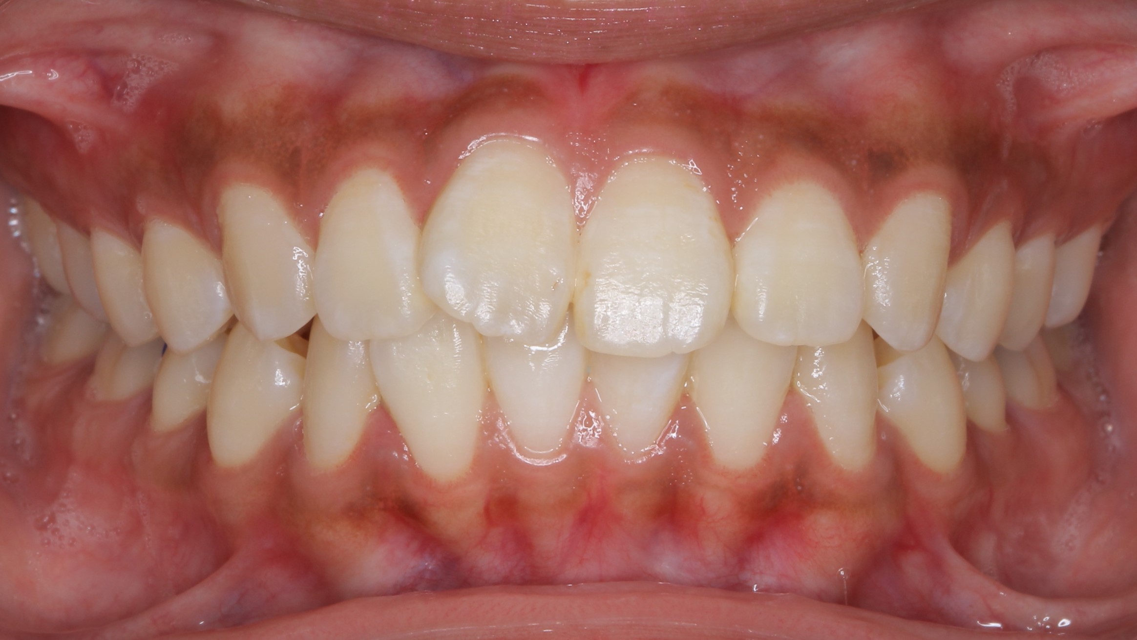 出っ歯・口ゴボの治療例２